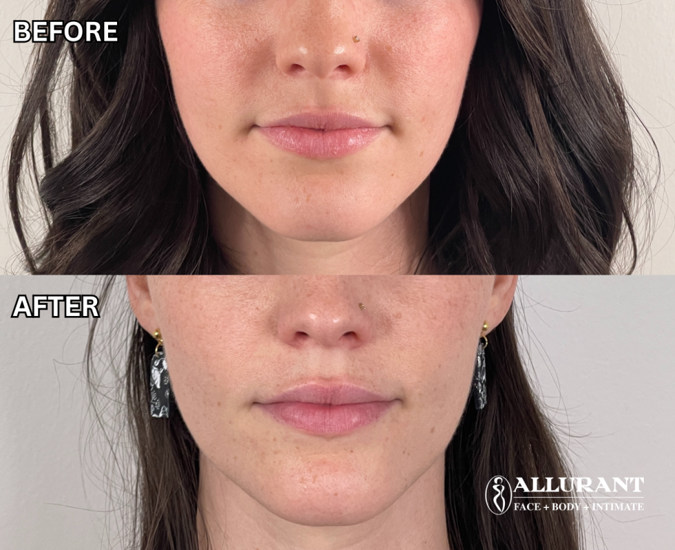 DERMAL FILLER TO CHIN B&A (alexis armstrong)