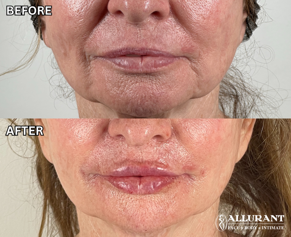 DERMAL FILLER TO LIPS + MARIONETTE LINES B&A (BIGGER)
