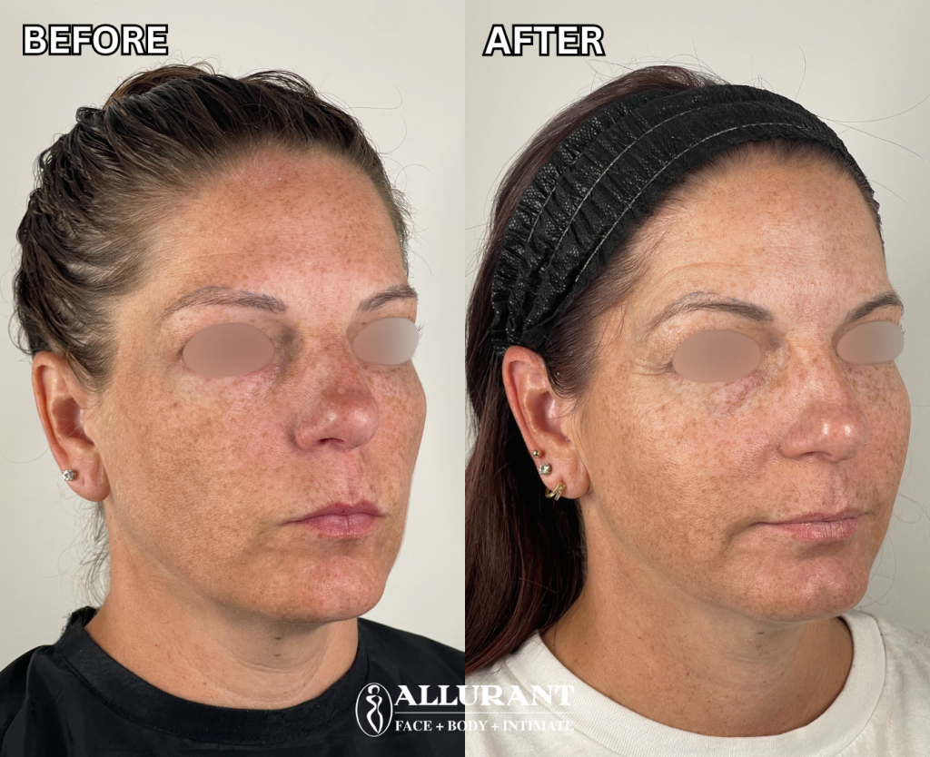EMFACE before and after results improving facial lift and wrinkle reduction at Allurant Medical Spa San Diego