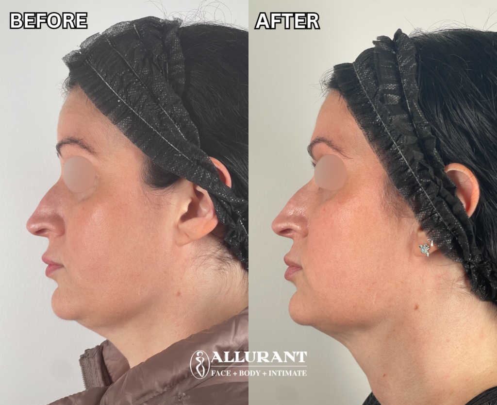 EMFACE treatment results showing smoother skin and lifted facial contours San Diego medical spa