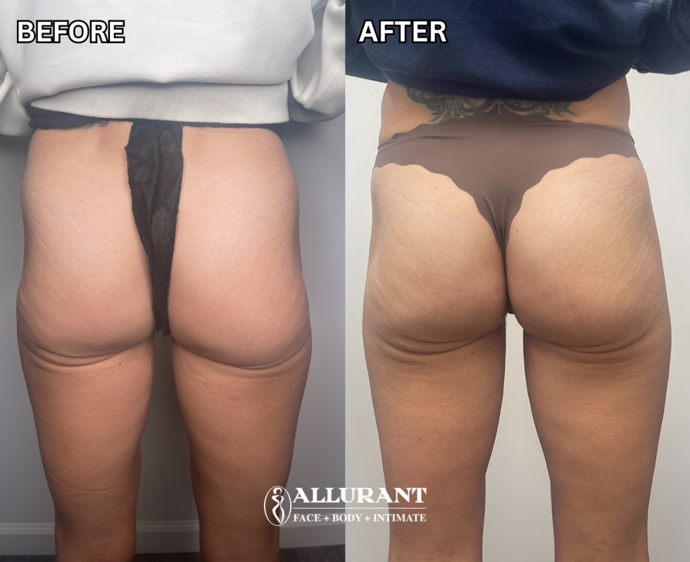 Before and after EMSCULPT treatment showing buttock contour and muscle toning results at a medical spa