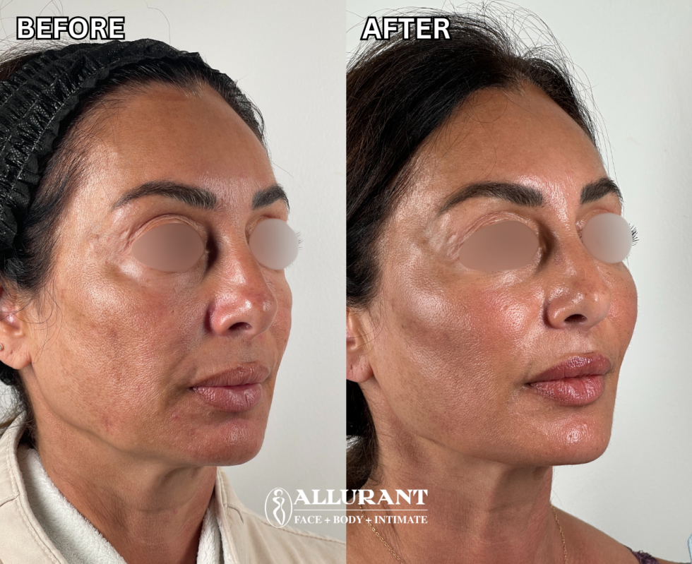 FAT TRANSFER TO FACE B&A