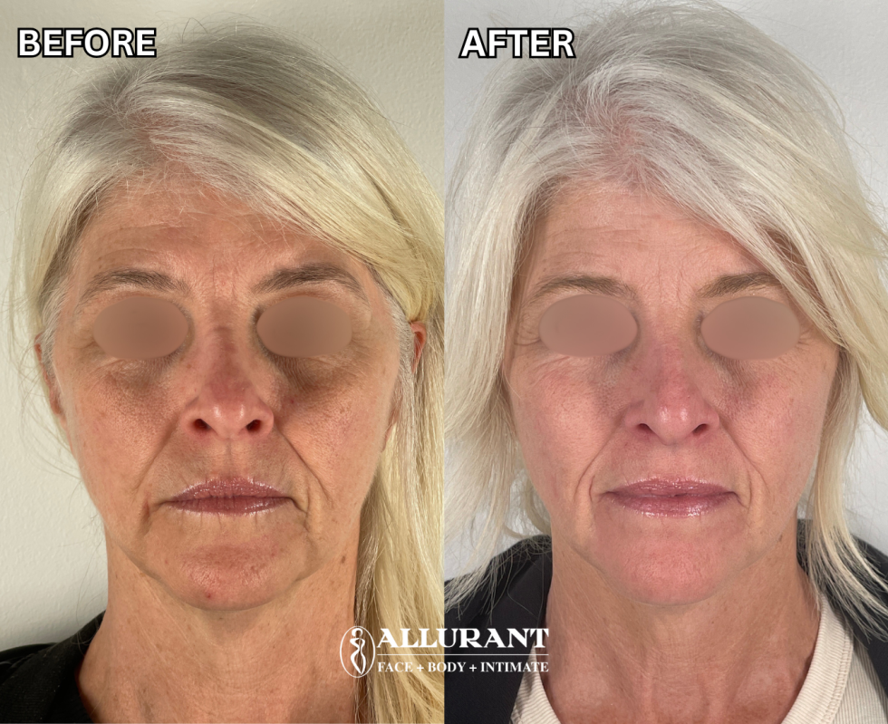 IPL PHOTOFACIAL + RF MICRONEEDLING B&A