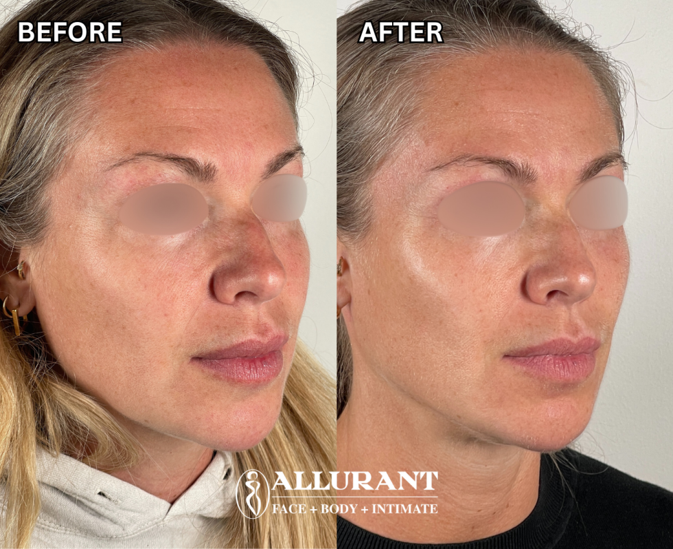 JOSIE HANEY SCULPTRA FACIAL RESHAPING B&A