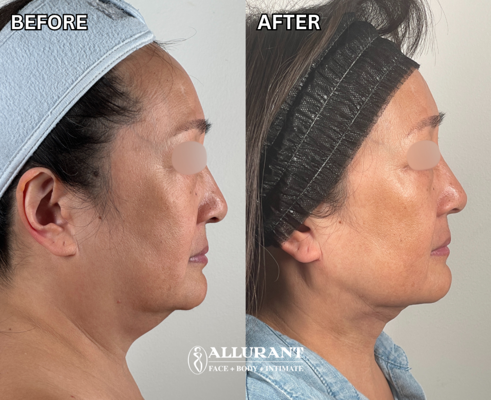 LASER LIPOSUCTION TO CHIN B&A