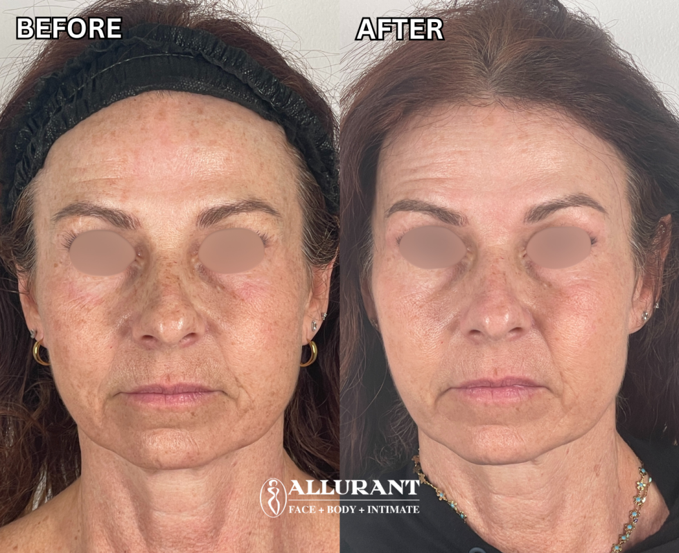 OPUS PLASMA B&A (lynn tardiff)