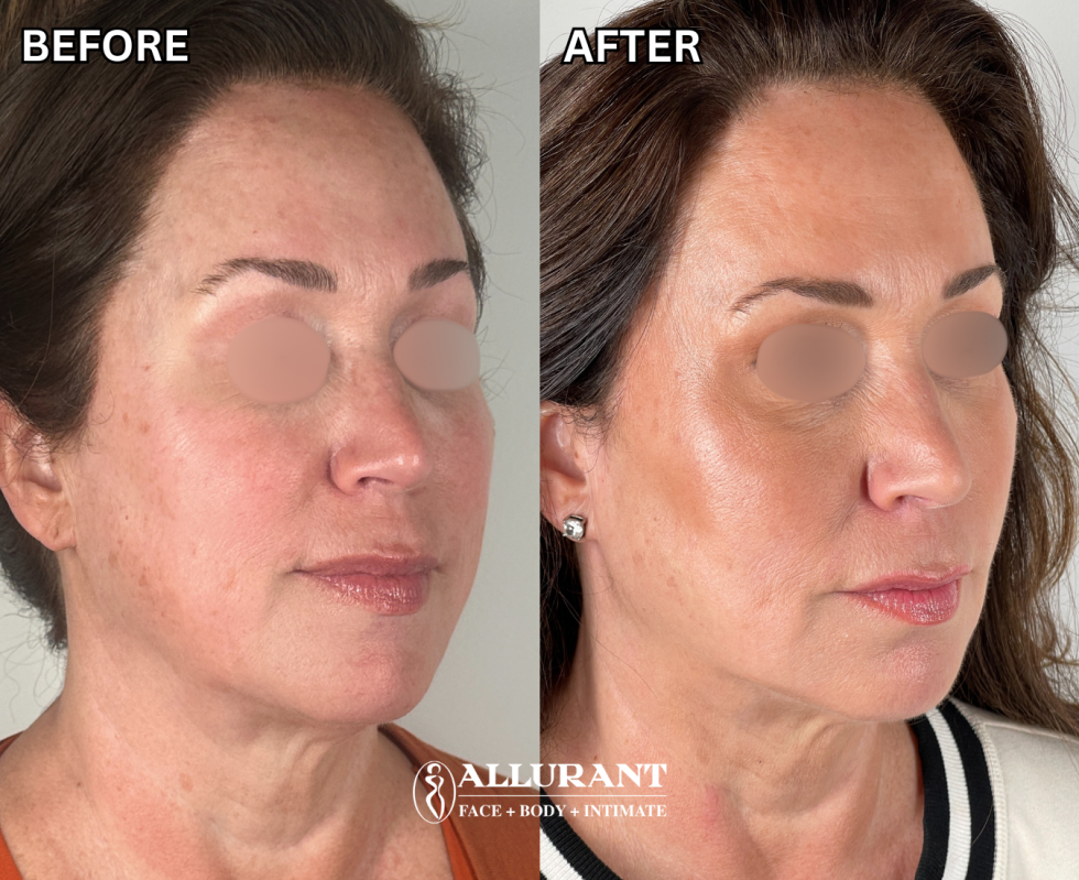 PDO THREADS B&A (melissa fargo)