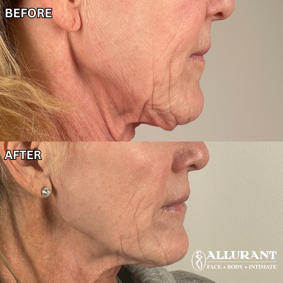 PDO THREADS TO LOWER FACE_ JAWLINE B&A (colleen lambert)