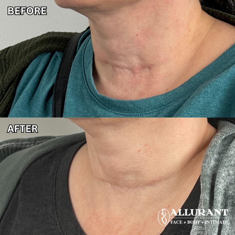 PRF THERAPY TO NECK SCAR B&A (rachelle trial)