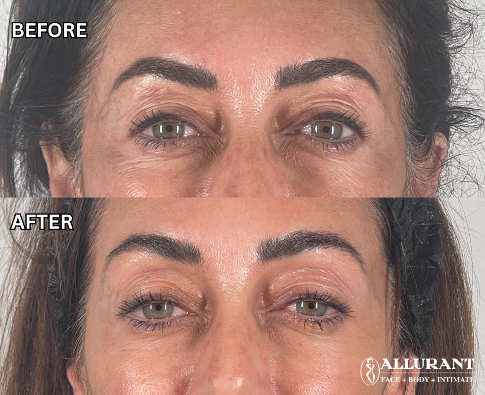 PRF UNDER EYE B&A