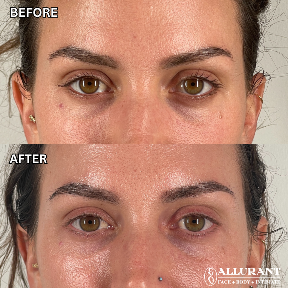 PRF UNDEREYE B&A (1)