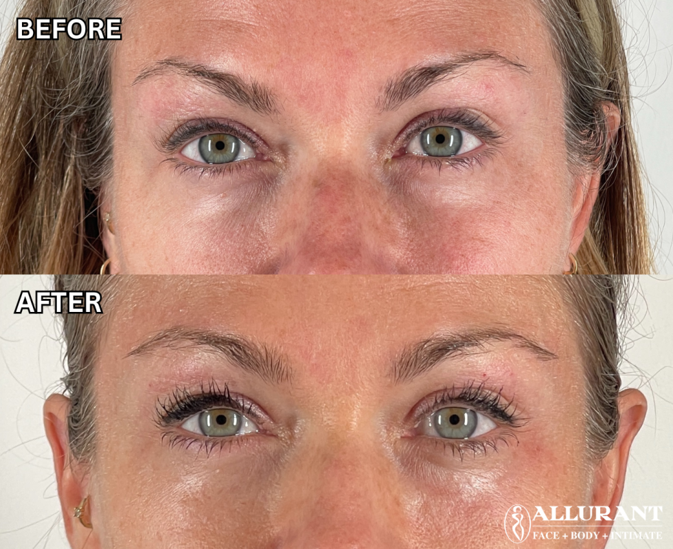 PRF UNDEREYE B&A