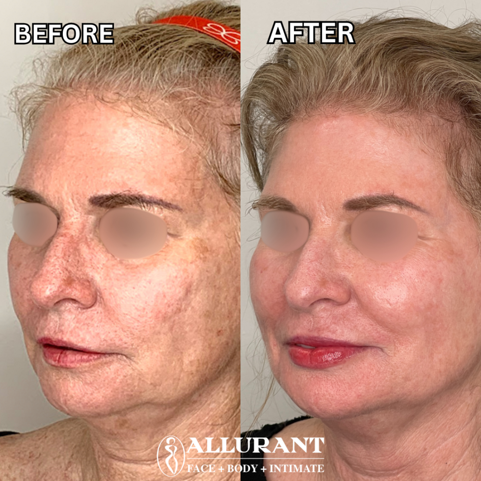 RF MICRONEEDLING B&A 2