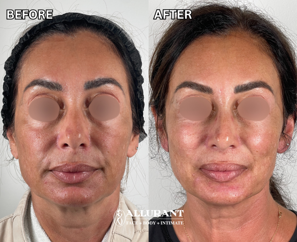 RF MICRONEEDLING B&A