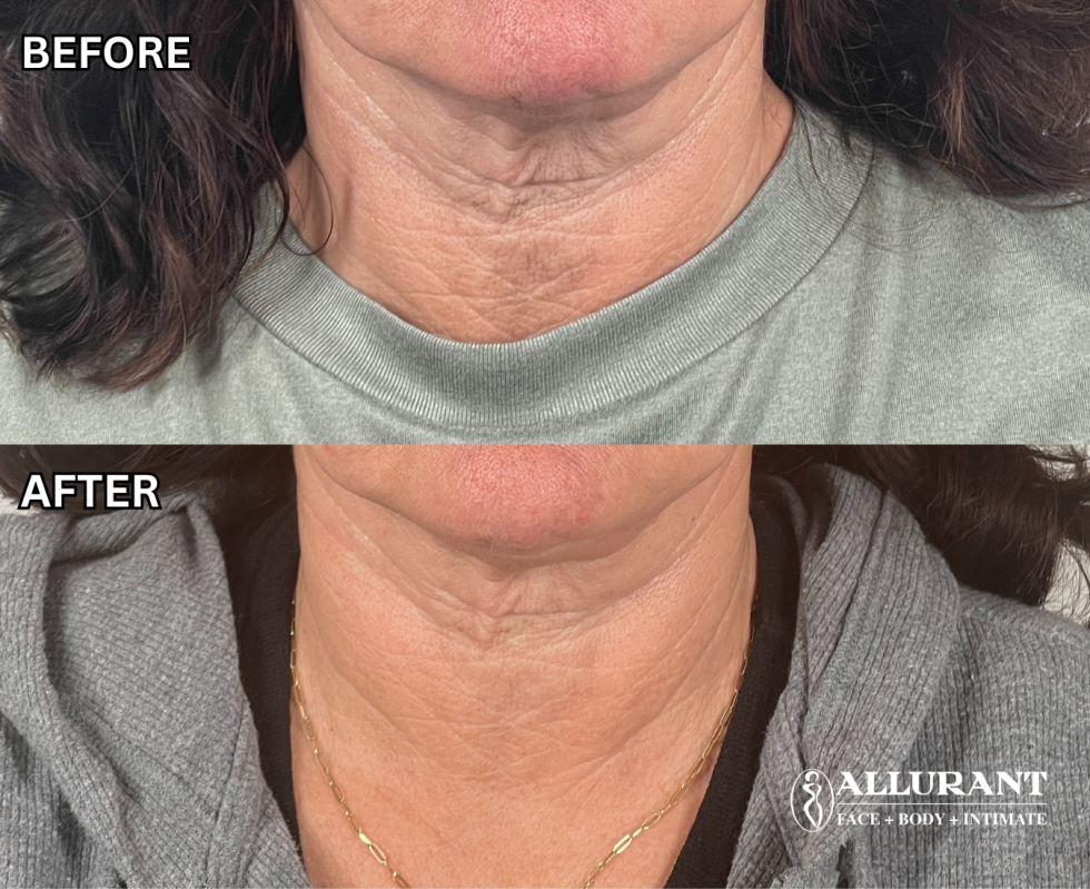 RF MICRONEEDLING + BOTOX TO THE NECK B&A (denise briggs)