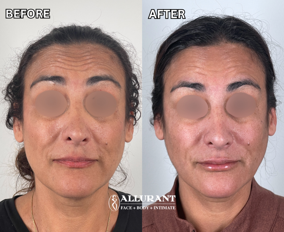 SAPIDAH SHEFA BOTOX TO FOREHEAD LINES B&A