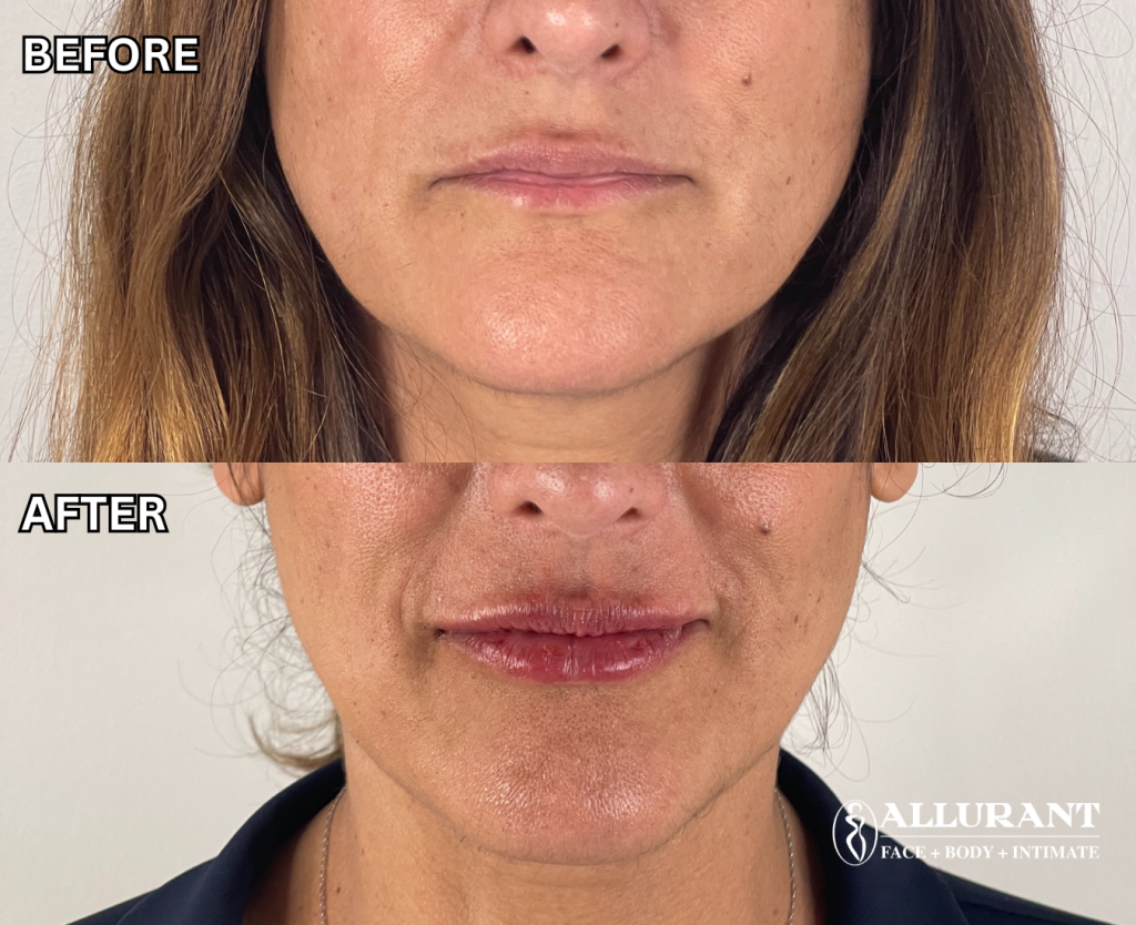 lip filler before and after results natural lip augmentation San Diego dermal filler treatment