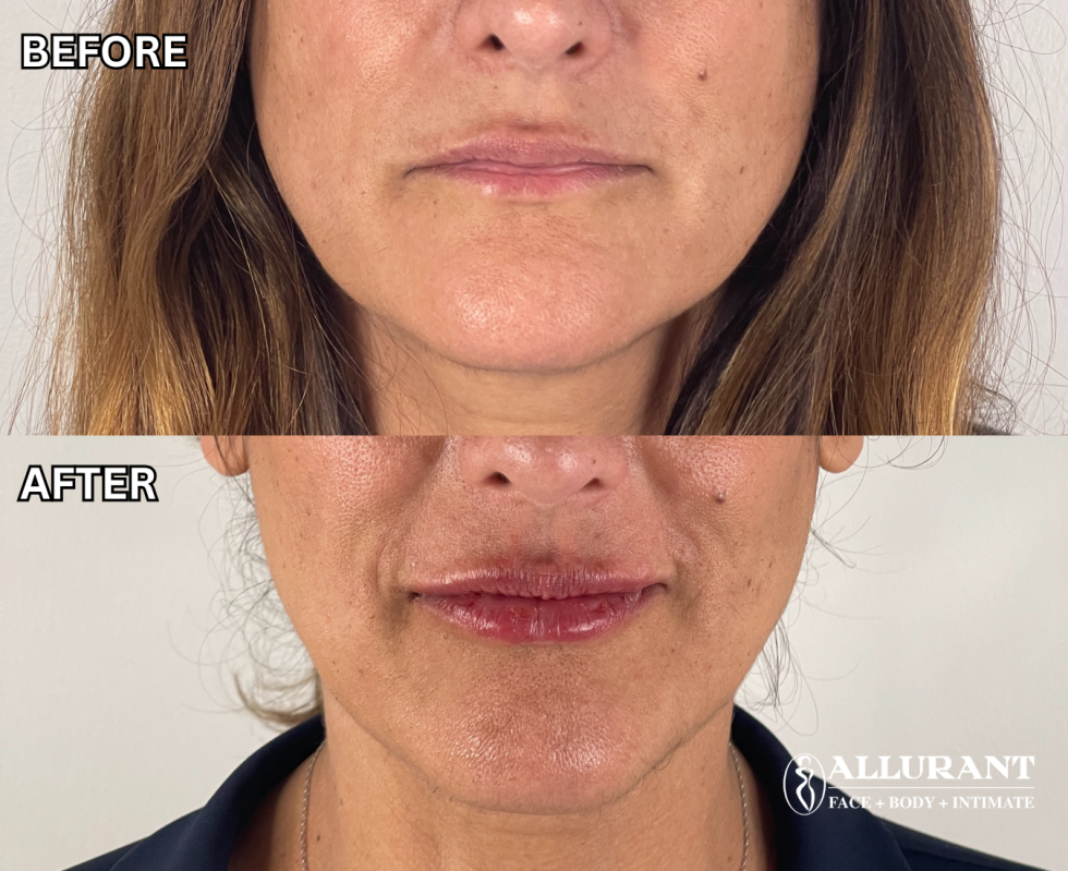 lip filler before and after results natural lip augmentation San Diego dermal filler treatment