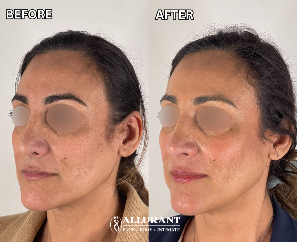SAPIDAH SHEFA RADIESSE TO CHEEKS B&A