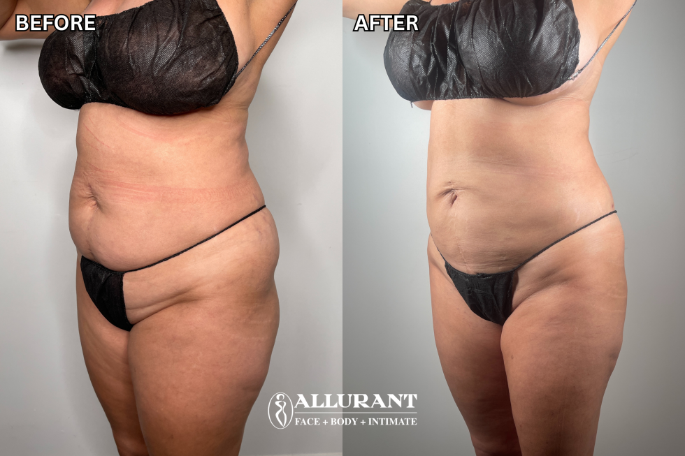 SEMAGLUTIDE GLP1 + EVOLVE X - ACCELERATED MEDICAL WEIGHT LOSS B&A (natalie dipiero)