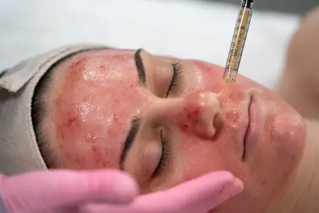 Patient with smoother healthier skin after a Vampire Facial San Diego treatment