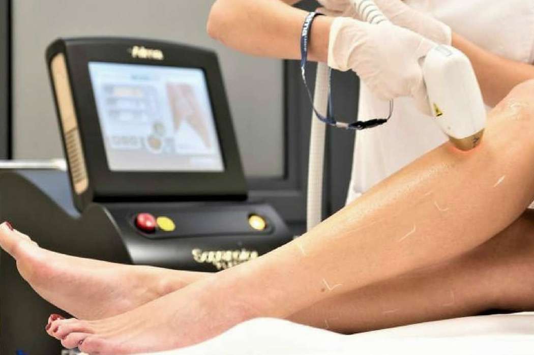 Pain-free laser hair removal treatment for smooth skin in San Diego