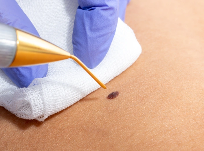 Mole removal results in San Diego with improved skin appearance and natural healing