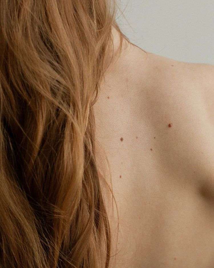 Professional mole removal treatment in San Diego targeting unwanted moles and skin lesions