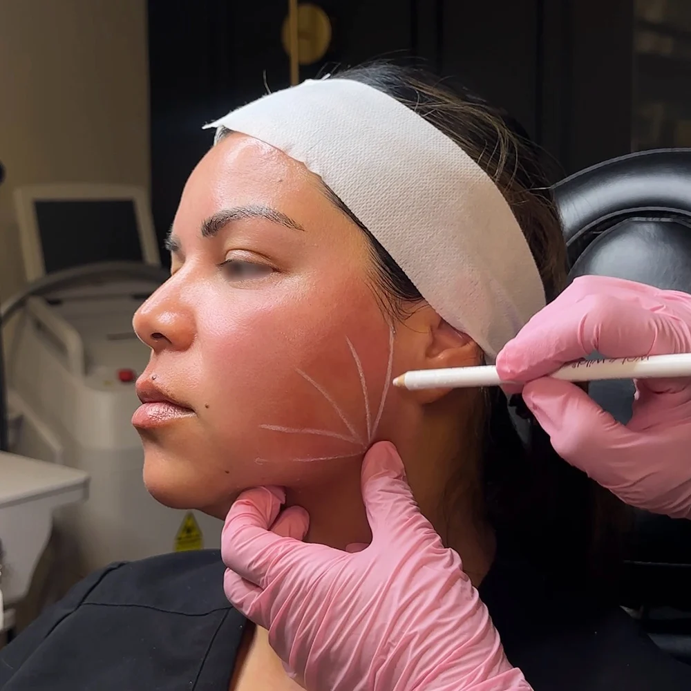 Patient receiving Sculptra injections for facial volume restoration in San Diego