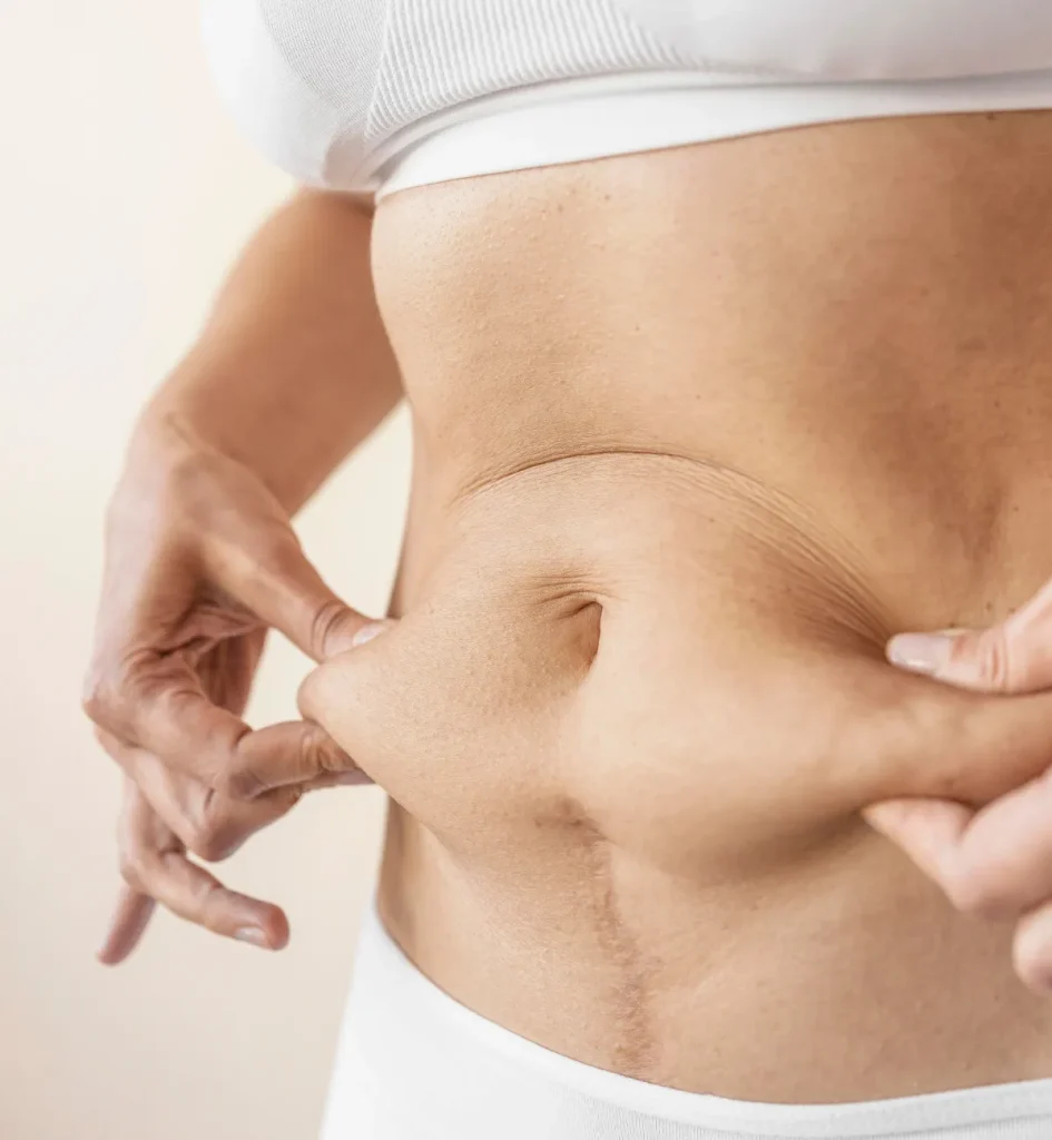 Body skin tightening treatment in San Diego for arms and abdomen