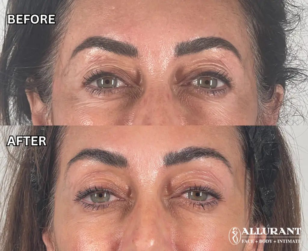 Before and after PRF under eye filler results at Allurant Medical Spa San Diego