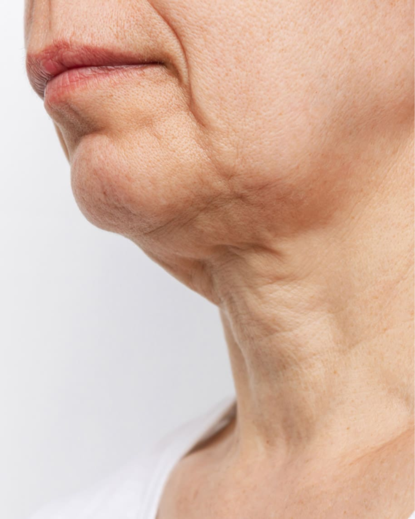 Non-surgical facial tightening treatment for sagging skin in San Diego