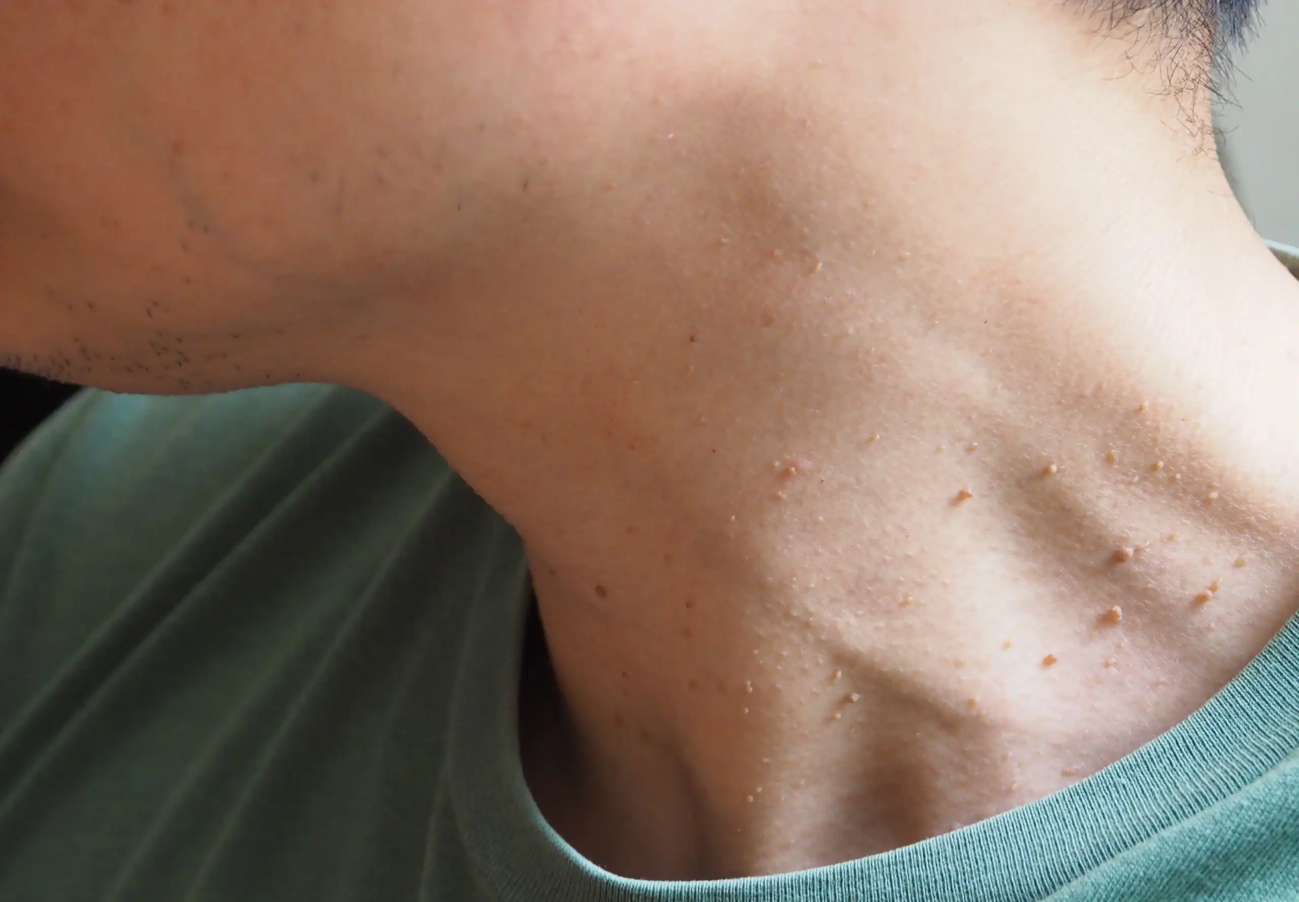 Safe and precise skin tag removal procedure performed by Allurant Medical Spa provider in San Diego