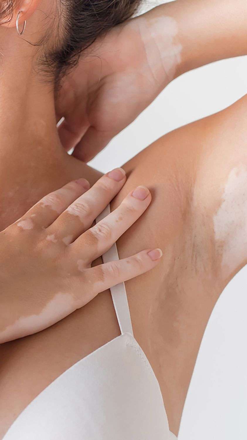 Underarm discoloration treatment in San Diego to brighten dark underarms and even skin tone