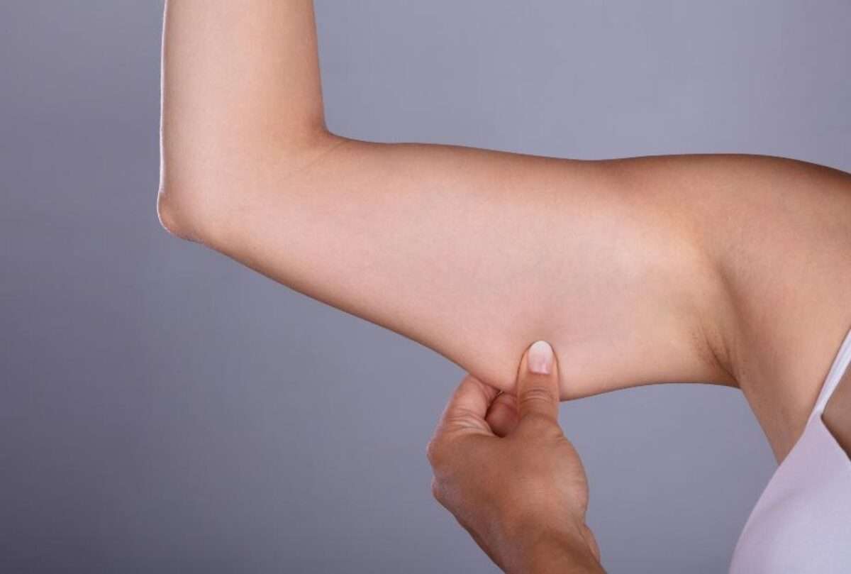 Upper arm fat stubborn arm fat consultation non surgical arm contouring Allurant Medical Spa San Diego
