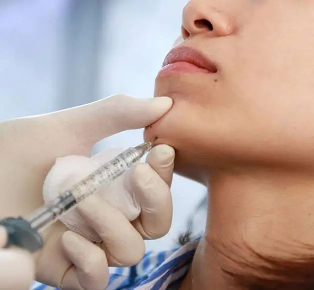 Chin filler treatment facial symmetry correction Juvederm Restylane San Diego medical spa