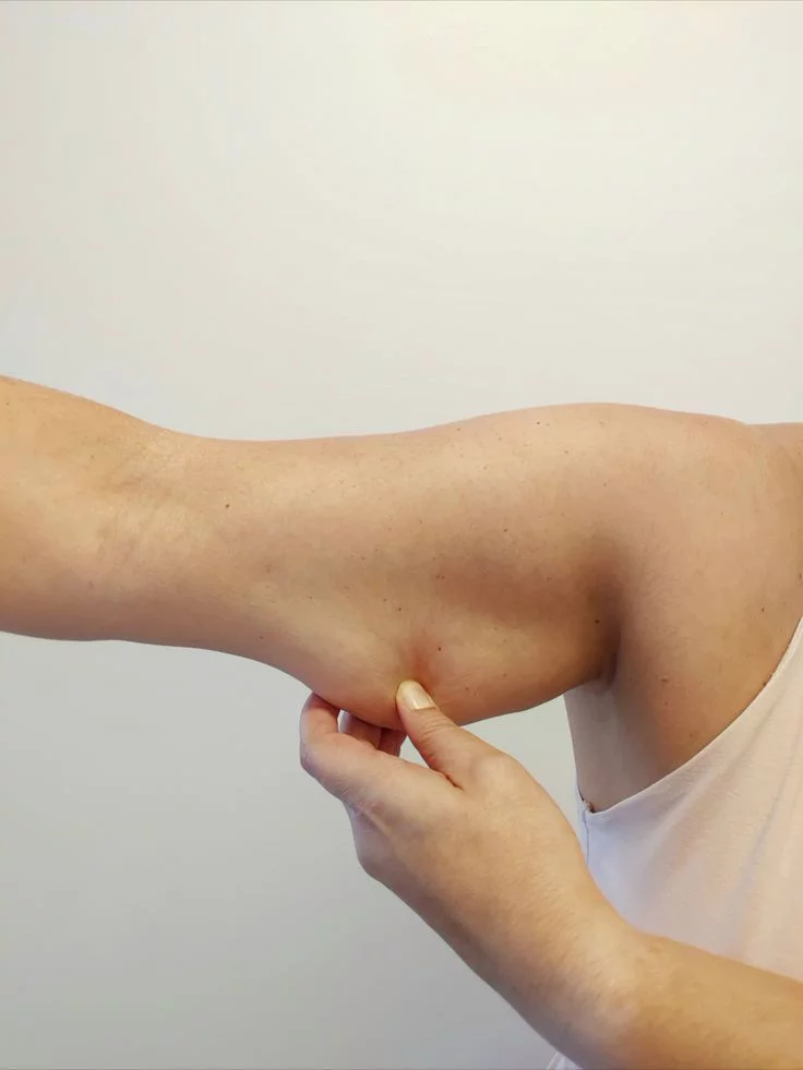 Arm skin laxity arm flaps loose upper arm skin collagen loss aging Allurant Medical Spa San Diego
