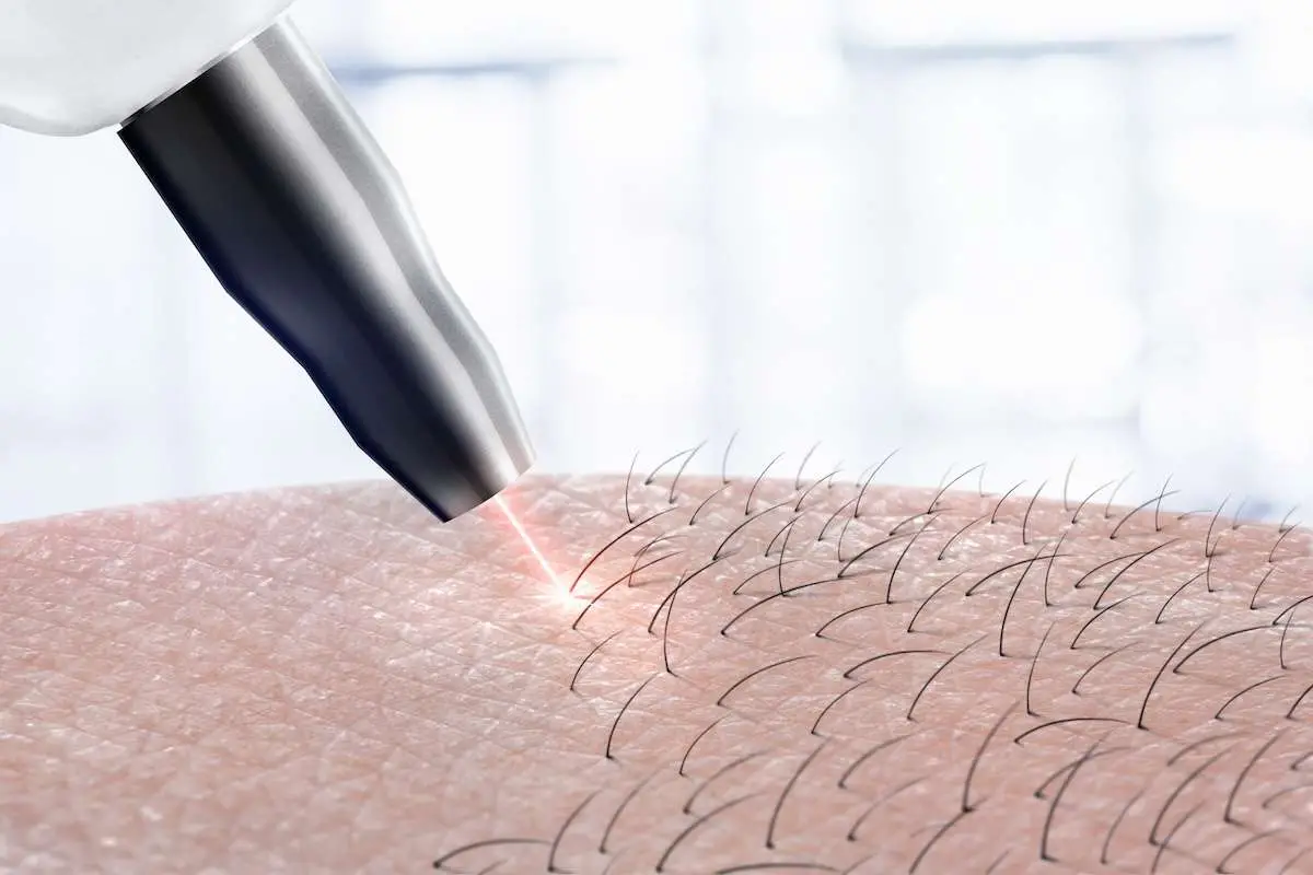 Woman receiving laser hair removal treatment at Allurant Medical Spa in San Diego