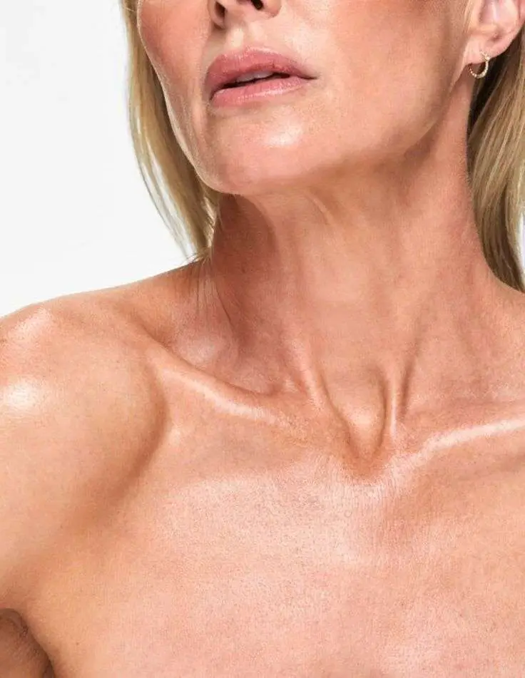 Clear smooth chest results after chest treatment skin rejuvenation Allurant Medical Spa San Diego
