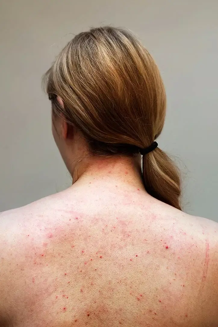 Back acne scarring bra line fat muscle tone back skin concerns treatment San Diego