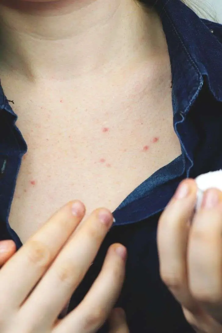 Chest acne redness skin damage before chest treatment IPL Adva TX San Diego Allurant Medical Spa