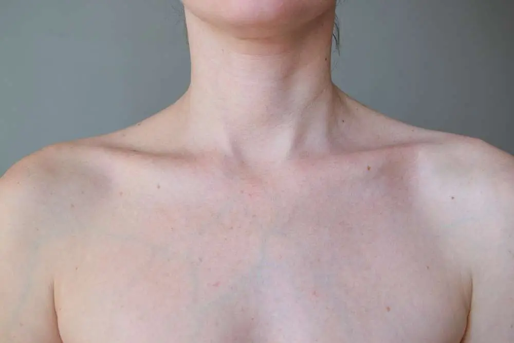 Patient chest before chest treatment consultation skin damage sun spots Allurant Medical Spa San Diego