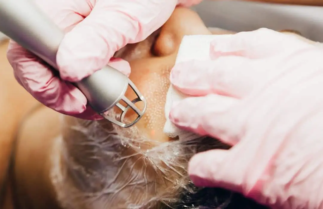 CO2 laser resurfacing procedure for skin texture and tone improvement in San Diego