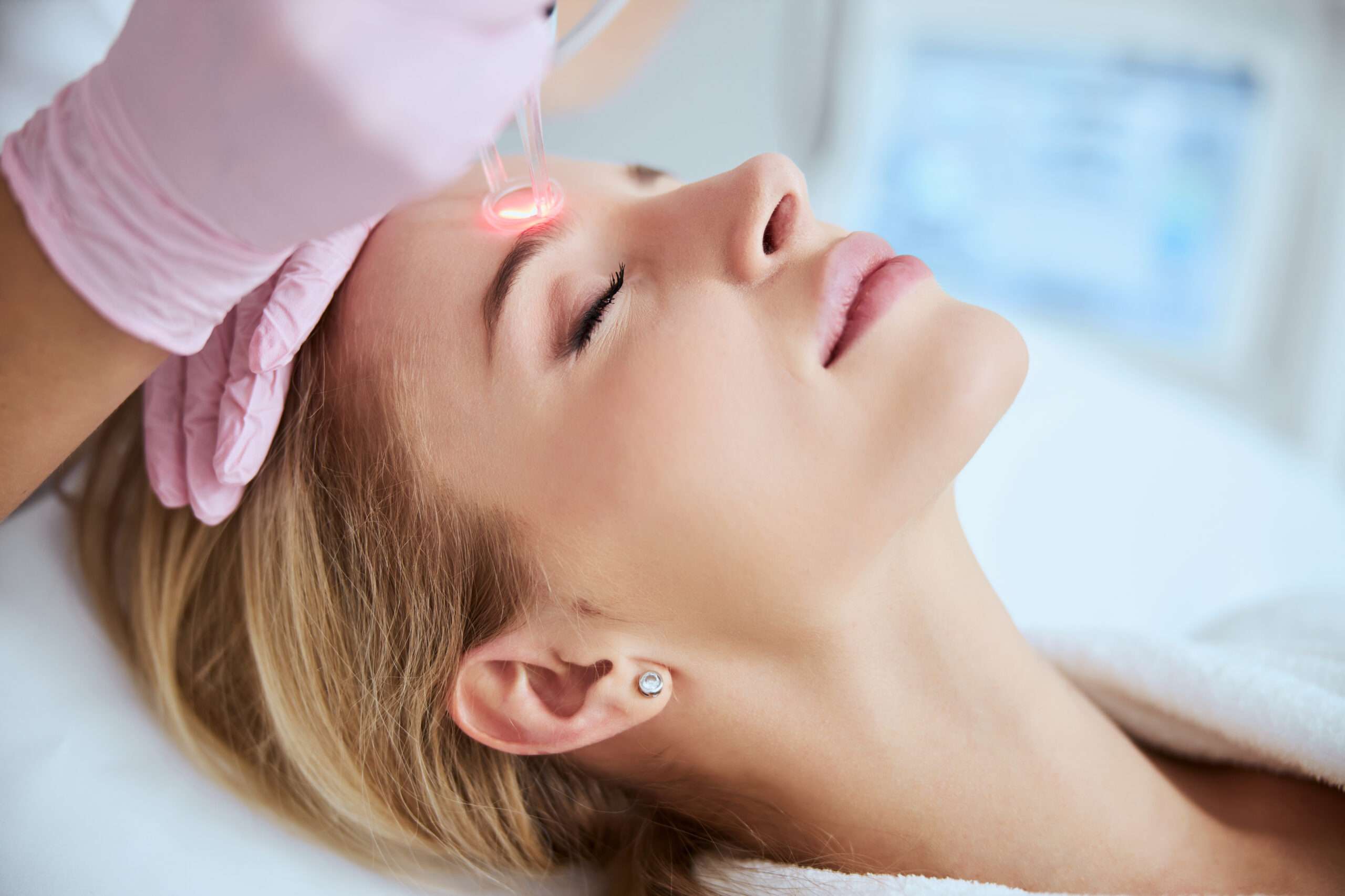 Fractional CO2 laser treatment for acne scars and wrinkles at Allurant Medical Spa in San Diego