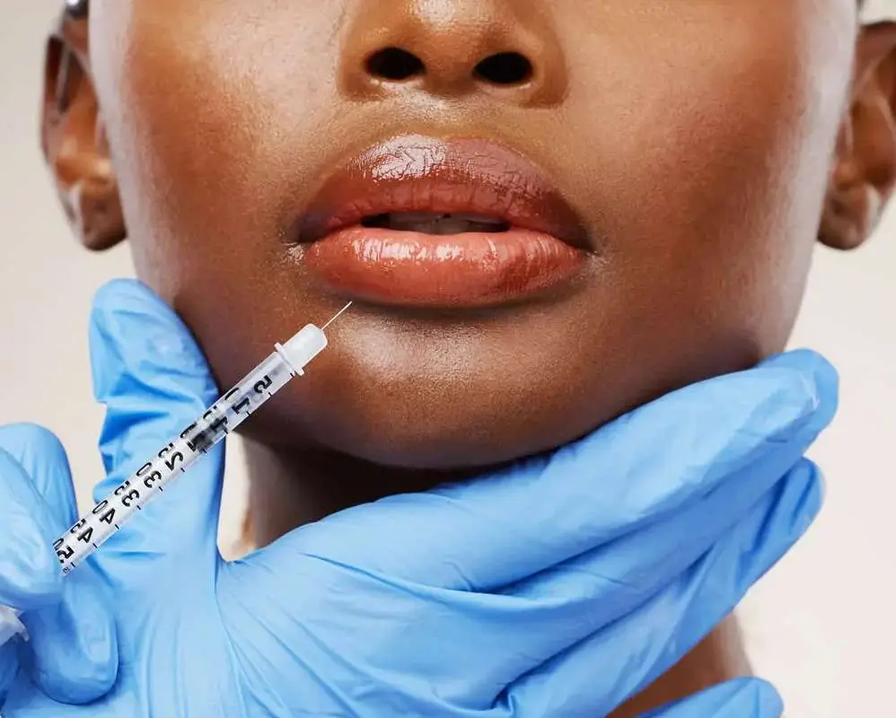 Filler dissolution and hyaluronidase treatment for unwanted dermal filler in San Diego