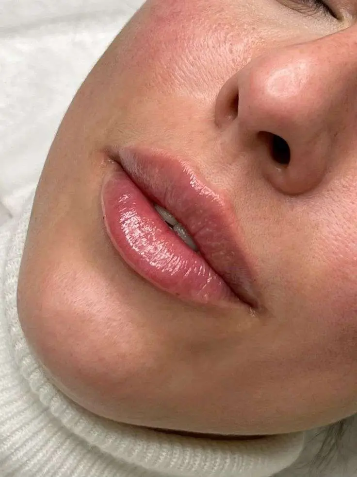 Symmetrical plump hydrated lips immediately after Juvederm Restylane lip filler treatment at Allurant Medical Spa San Diego
