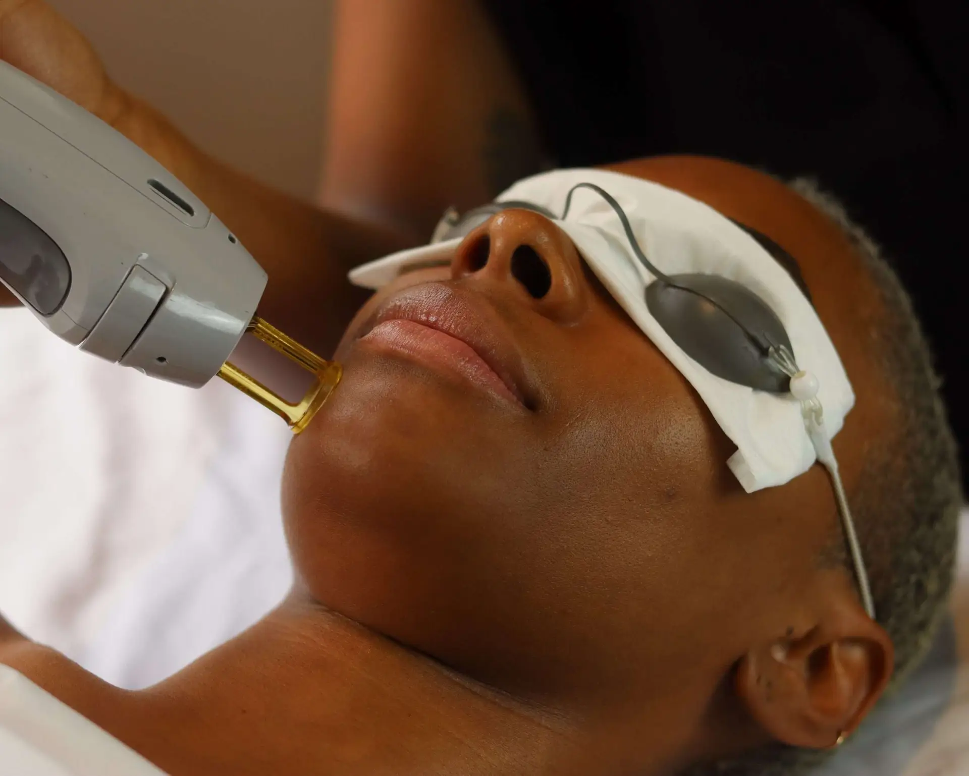 Soprano Ice Platinum device in use for laser hair removal on dark skin tones at Allurant Medical San Diego