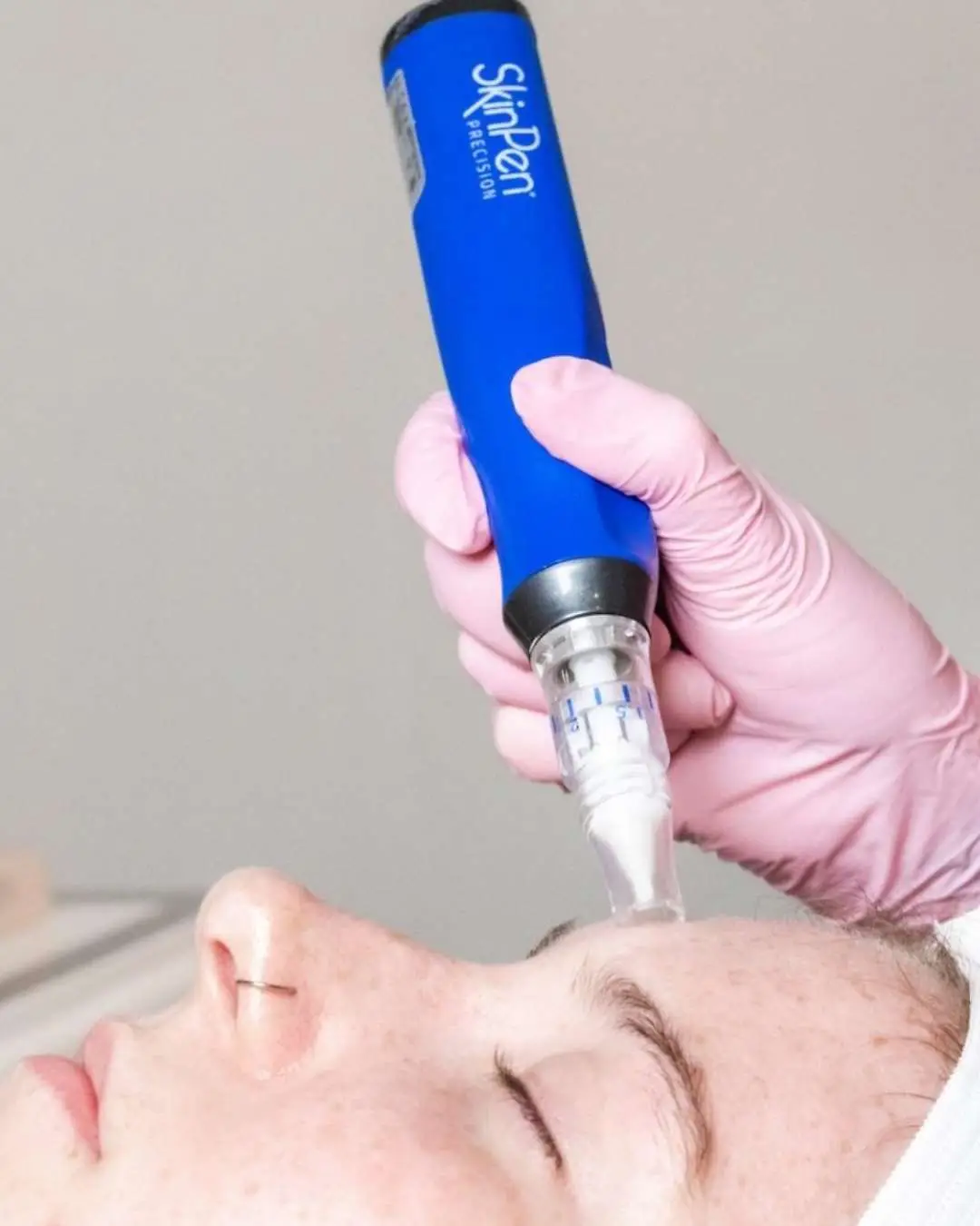 Physician-directed microneedling treatment in San Diego at Allurant Medical Spa for skin rejuvenation