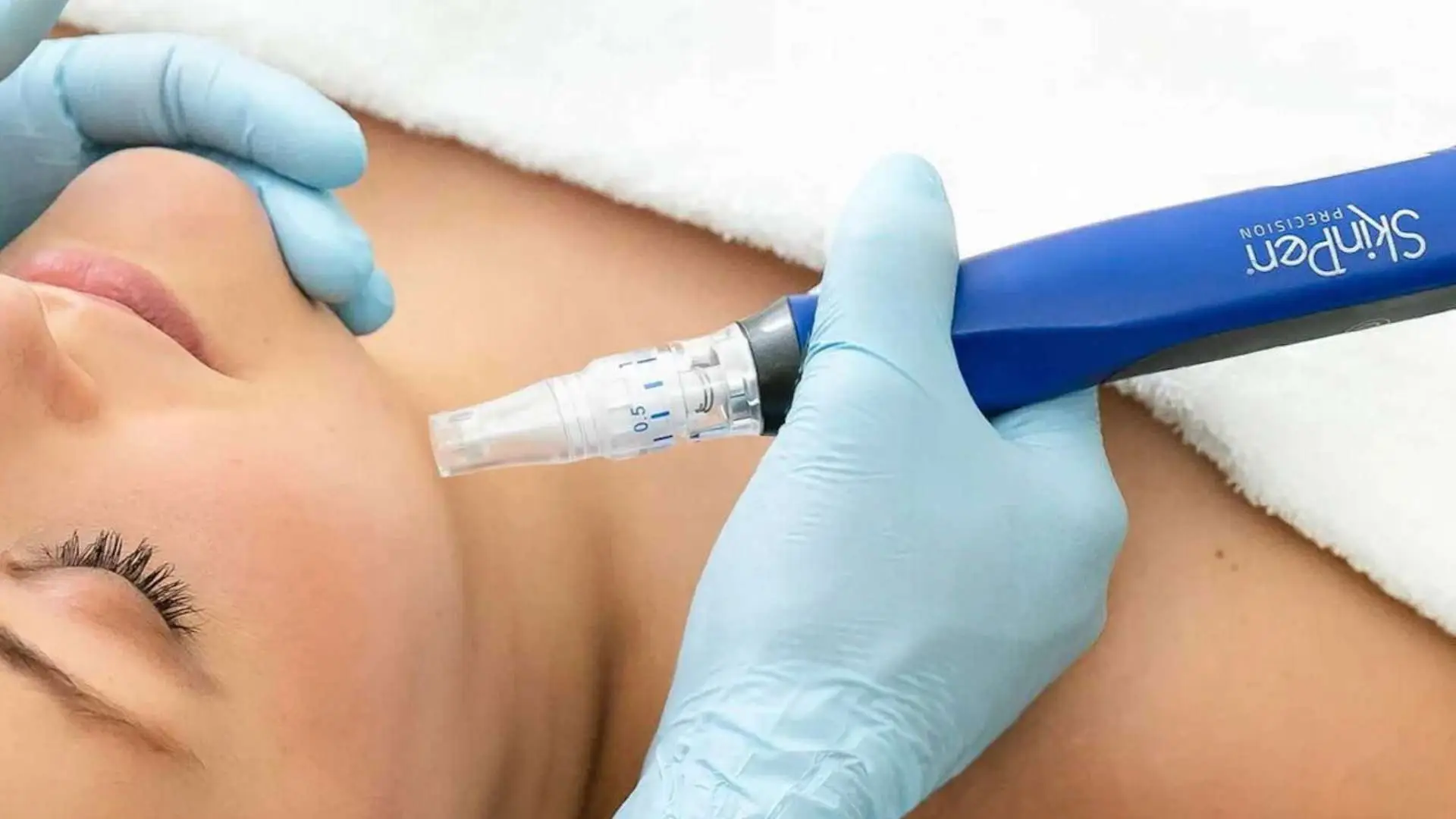 Microneedling treatment in San Diego at Allurant Medical Spa targeting acne scars and uneven skin texture