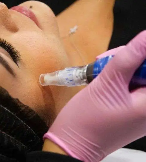 Licensed practitioner performing microneedling in San Diego at Allurant Medical Spa for collagen induction